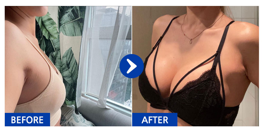 [강남언니] 가슴성형(모티바) / 5개월차/ 닉네임:Regina0