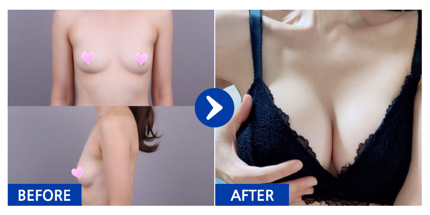 [강남언니] 가슴성형 / 1개월차/ 닉네임:aeae67