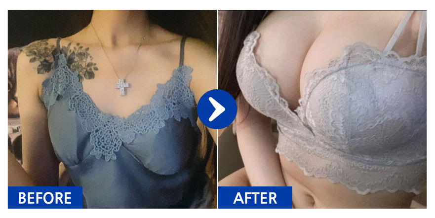 [강남언니] 가슴성형(세빈마텍) / 9개월차/ 닉네임:코손실와용