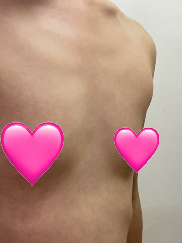 [Ngực] Nemo Beam - Ngực