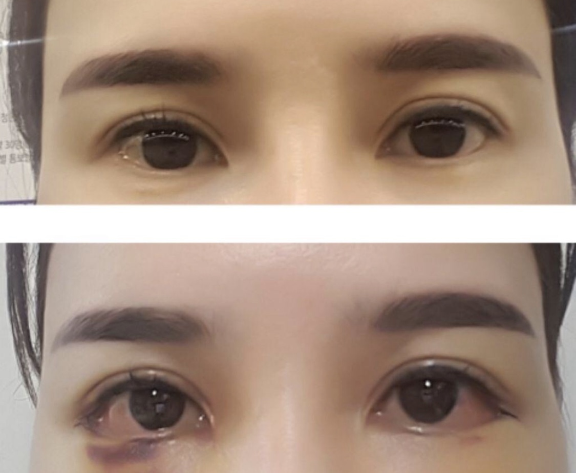 [Mắt] Sangkeumi Girl - Hạ góc mắt ngoài, mở rộng góc mắt trong