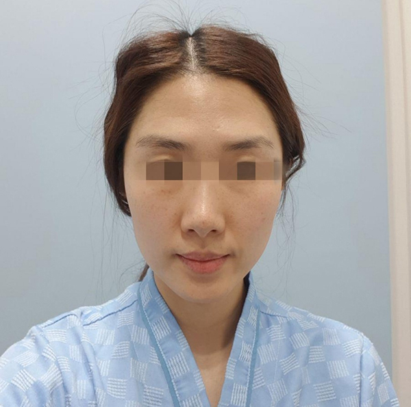 [Tiểu phẫu] Nhà BinBin - Cấy mỡ toàn mặt