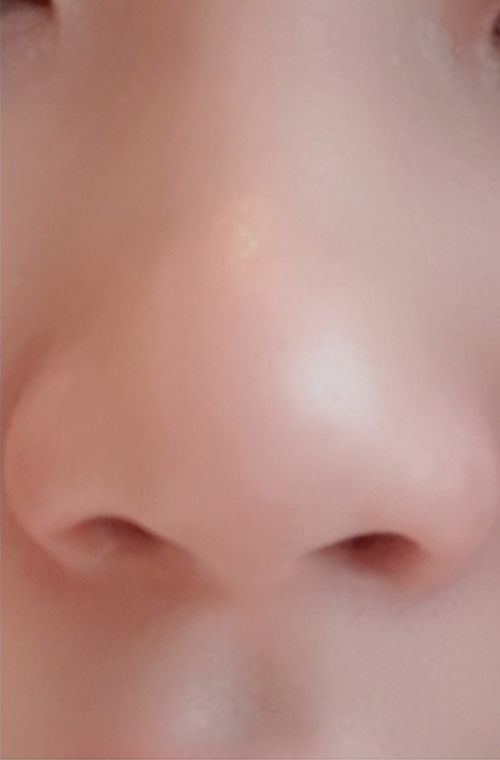 [Tiêm thẩm mỹ] 7 giờ 11 phút - Tiêm tan mỡ tạo hình mũi