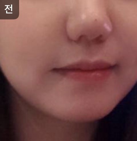 [Da] oy1004 - Nâng cơ, tiêm căng bóng