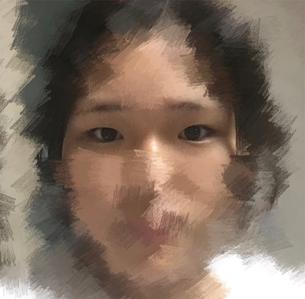 [Mắt] Jung Ye-seul - Mở góc mắt trong, chỉnh hình mắt