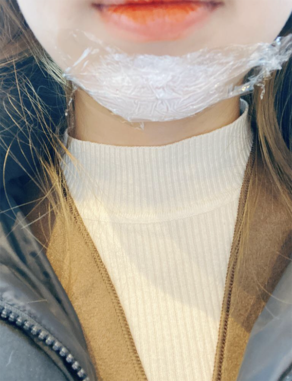 [Tiểu phẫu] Review 복츙ㅇㅏ뽑호 - Filler cằm, Botox