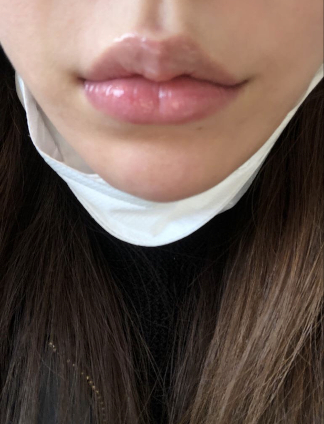 [Tiêm filler] vvkim - Filler