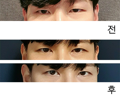 [Mắt] WDHH - Chỉnh sửa mí mắt