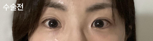 [Mắt] ㅈㅎㅊ - Mắt