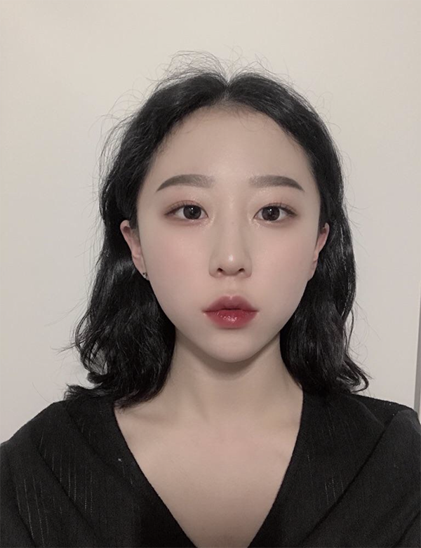 [Tiểu phẫu] Mangosuna đêm khuya - Botox, Filler