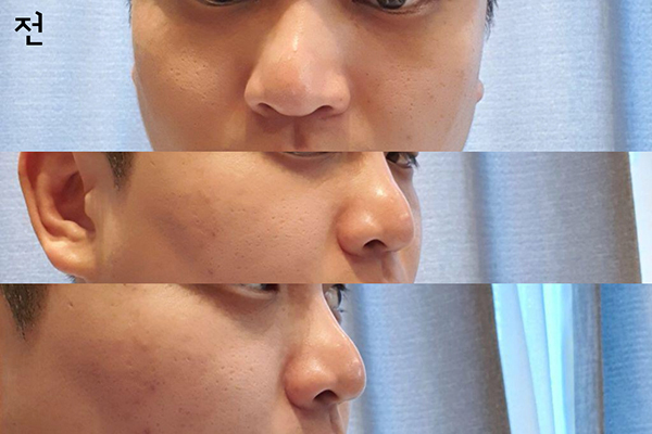 [Mũi] sh1987 - Mũi