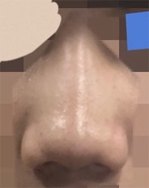 [Mũi] Gana Suesusu - Mũi