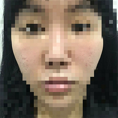 [Tiêm thẩm mỹ] yuyya - Tiêm tan mỡ