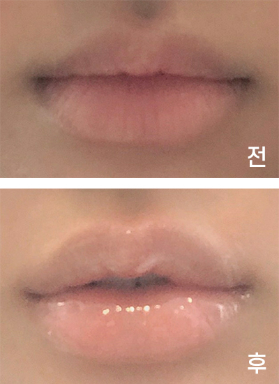 [Tiêm filler] ㅎ링ㅇ - Filler khóe miệng, môi