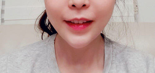 [Da] gus0311 - Filler, Nâng cơ