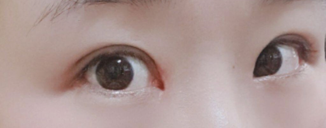 [Mắt] Pinggu Jjin - Chỉnh sửa mí mắt, mở góc mắt