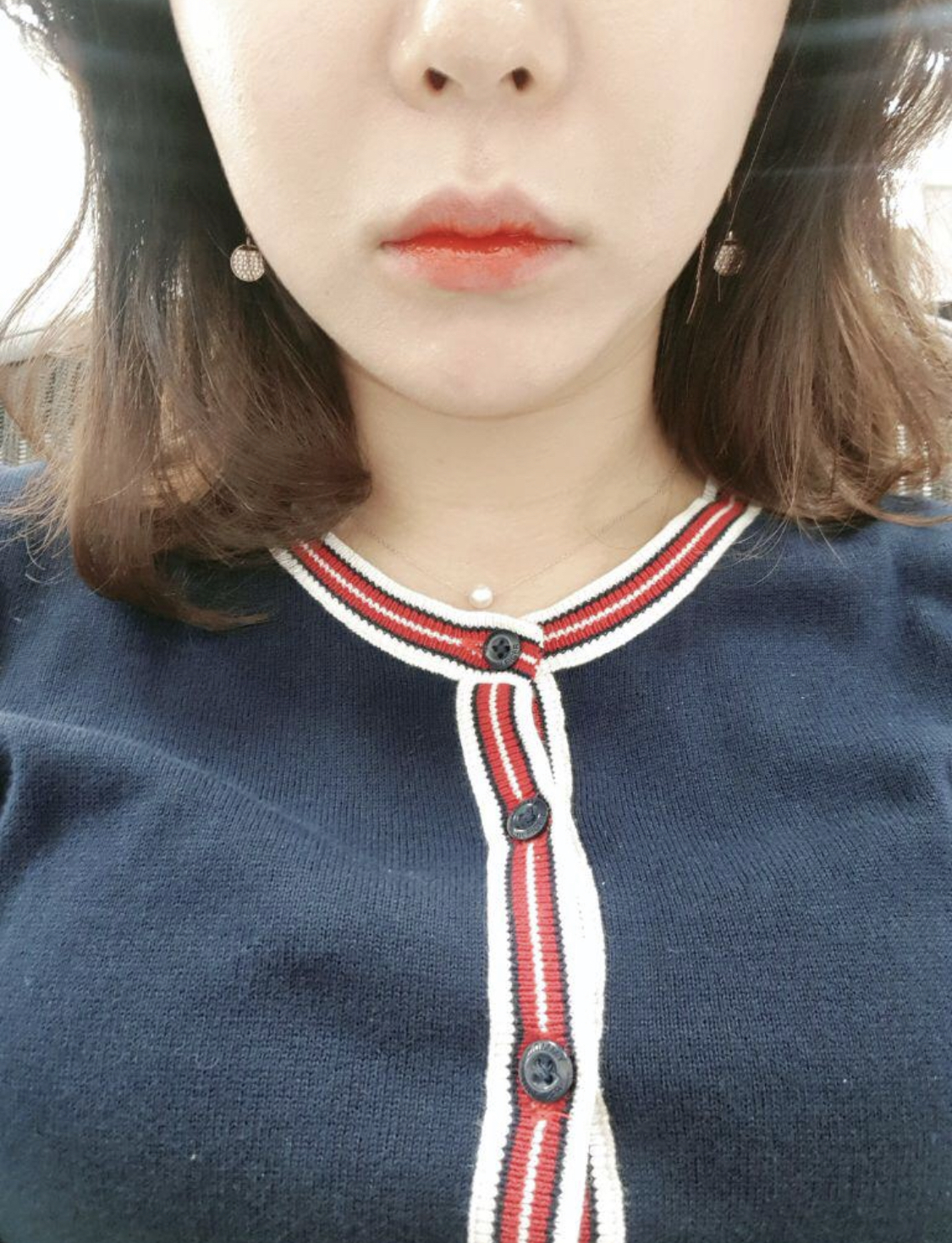 [Tiêm thẩm mỹ] Jeon Ssyoni - Botox, Tiêm Chanel