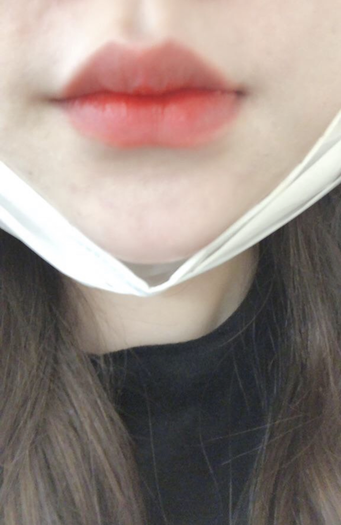 [Tiêm filler thẩm mỹ] Ririgeol - Tiêm filler môi