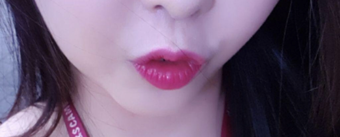 [Tiểu phẫu] Hoàng Kim Bit Leya - Filler, căng chỉ