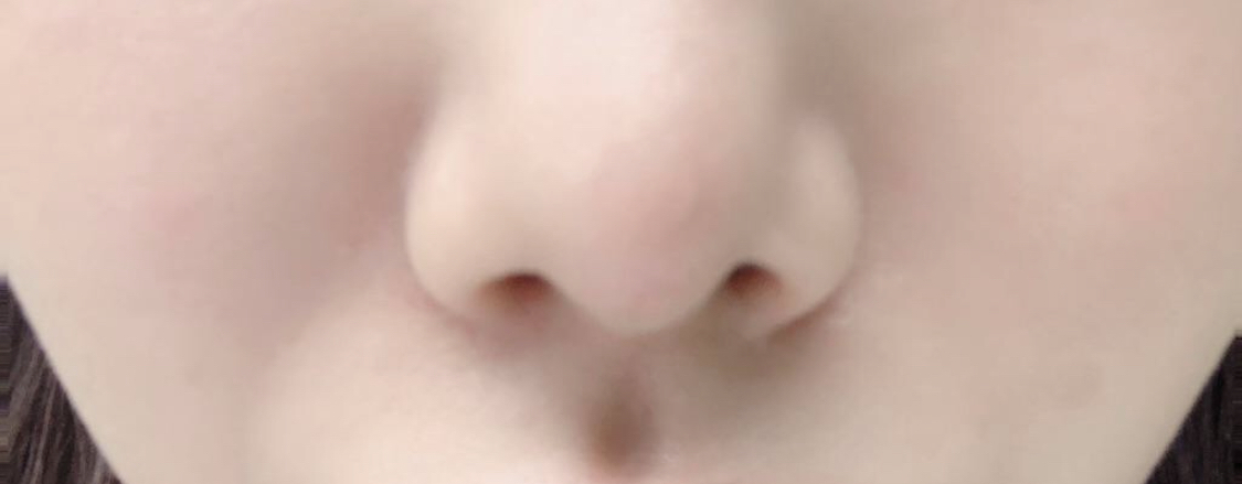 [Chống lão hóa] Wonivv - Cấy mỡ