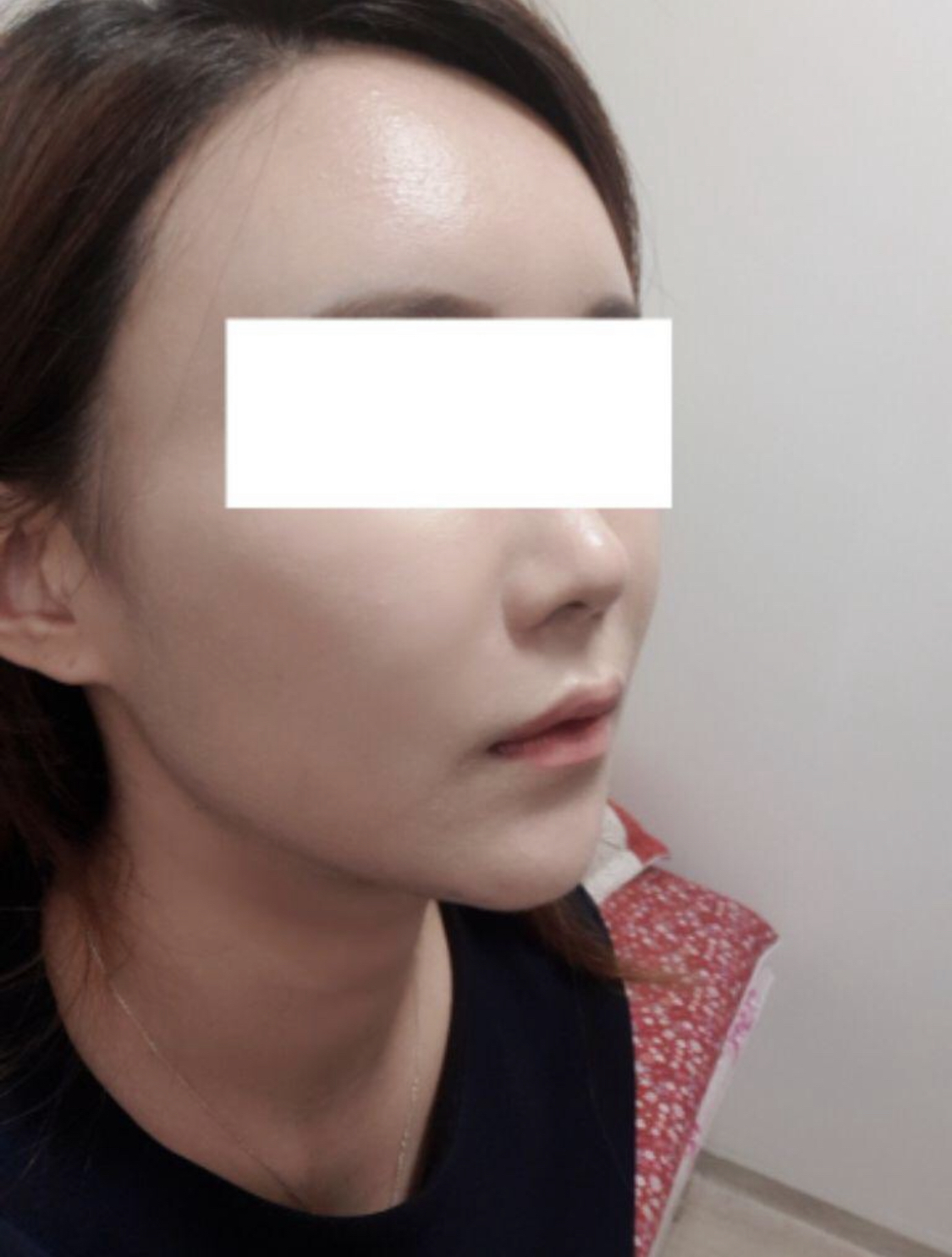 [Chống lão hóa] Kkarong - Cấy mỡ toàn mặt