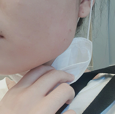 [Tiêm thẩm mỹ] seoul - Botox cằm