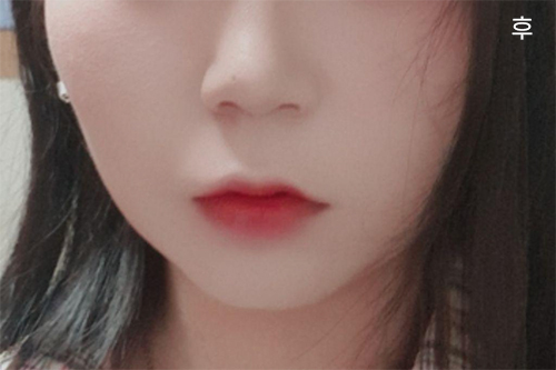 [Chống lão hóa] alss12 - Hút mỡ mặt