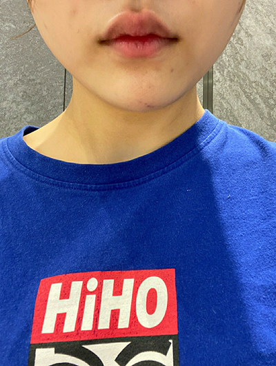 [Tiêm thẩm mỹ] Ji Yoon's - Botox góc hàm