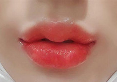 [Tiểu phẫu] Dahuiing - Filler