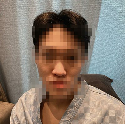 [Mũi] Sống mũi giun 2@ - Mũi