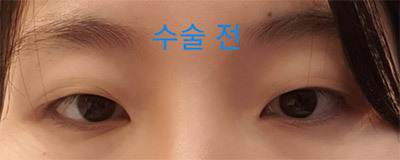 [Mắt] Bắn thẳng - Mắt