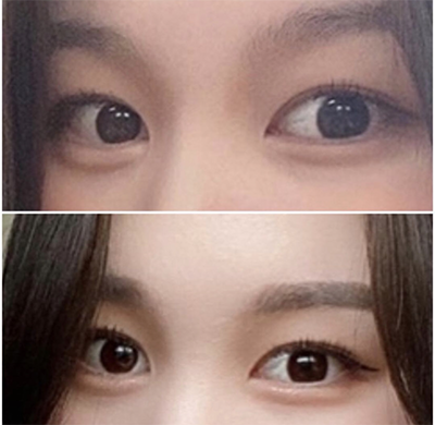 [Mắt] Yeondudoo - Cắt mí, Mở góc mắt