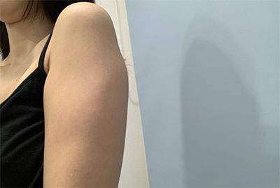 [Hút mỡ] Kkulralil - Hút mỡ cánh tay, ngực phụ