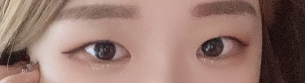 [Mắt] Rulryuu - Tái phẫu thuật mắt