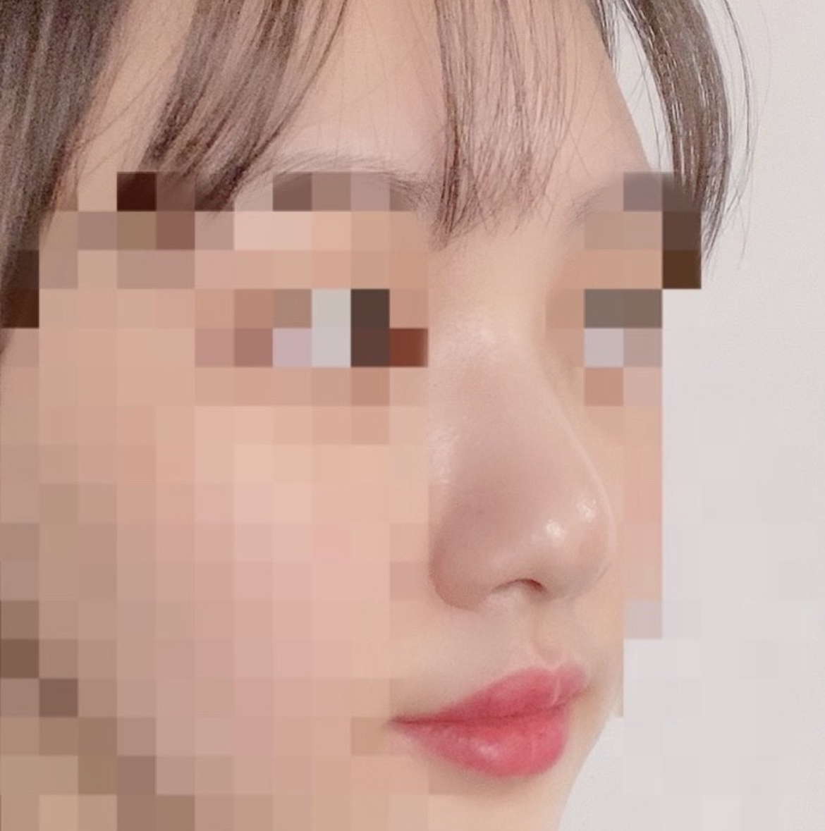 [Mũi] Longda - Phẫu thuật nâng mũi