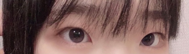 [Mắt] Kuromi s2 - Cắt mí (phương pháp cắt), mở góc mắt trước