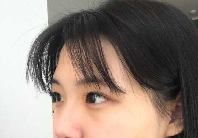 [Mắt] Ưng ắng - Cắt mí (liên kết tự nhiên), mở góc mắt trên