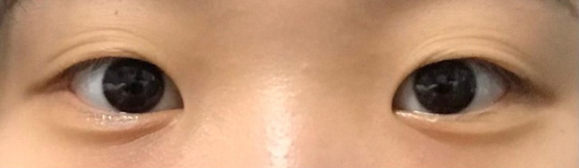 [Mắt] Dâu tây của mình - Mở góc mắt trong, Chỉnh sửa hình dáng mắt