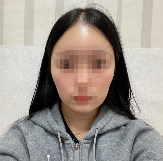 [Gọt mặt] Lemon55 - Phẫu thuật gọt hàm, thu gọn cằm