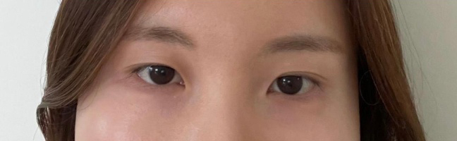 [Mắt] wyn - Mở góc mắt trong, Chỉnh sửa mí mắt