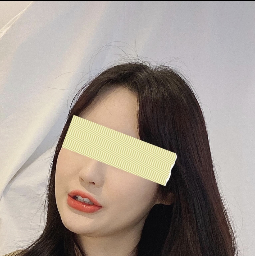 [Gọt mặt] Ước mơ về khuôn mặt V-line ㅎ - Gọt hàm vuông