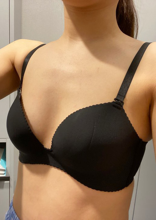 [Ngực] Lily - Nâng ngực