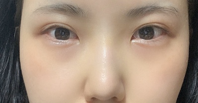 [Mắt] Sửa mắt và mũi