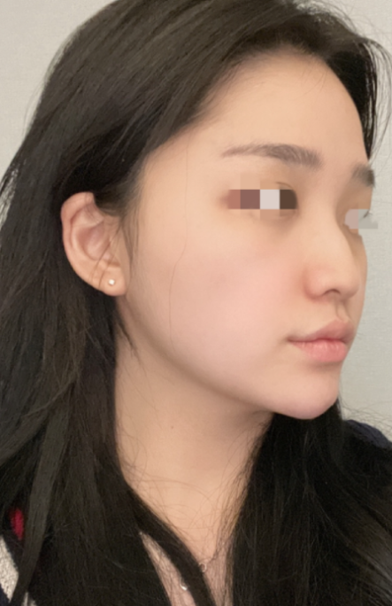 [Mũi] Tự tin hơn hẳn - Mũi