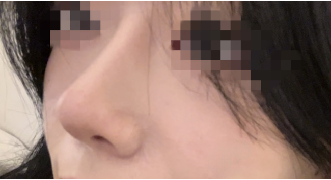 [Mũi] Mảnh thủy tinh - Mũi