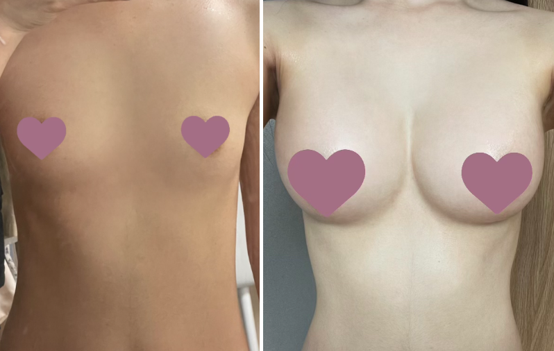 [Ngực] Lật Ngược - Ngực