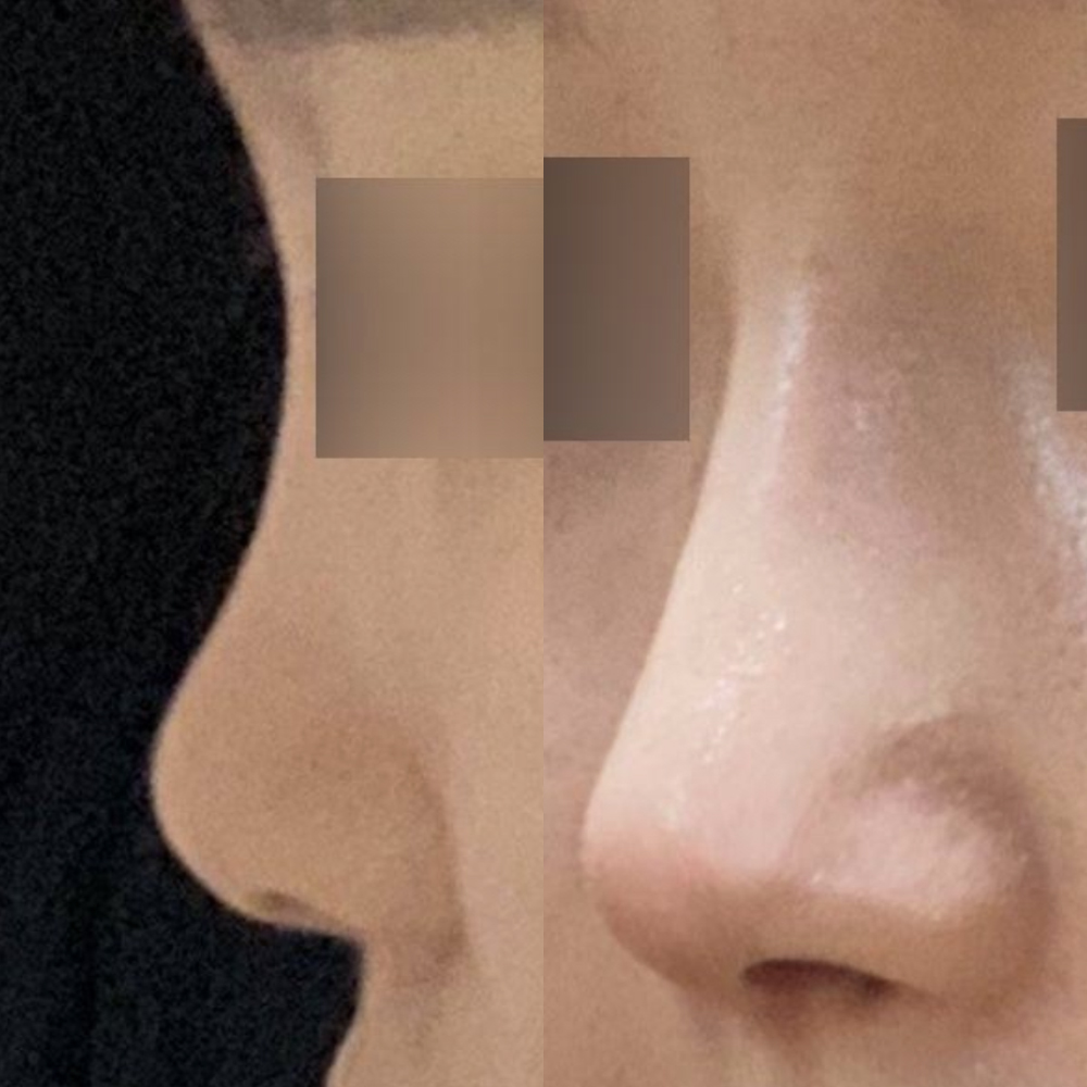 Mình đã phẫu thuật mũi lần đầu tại Weavers