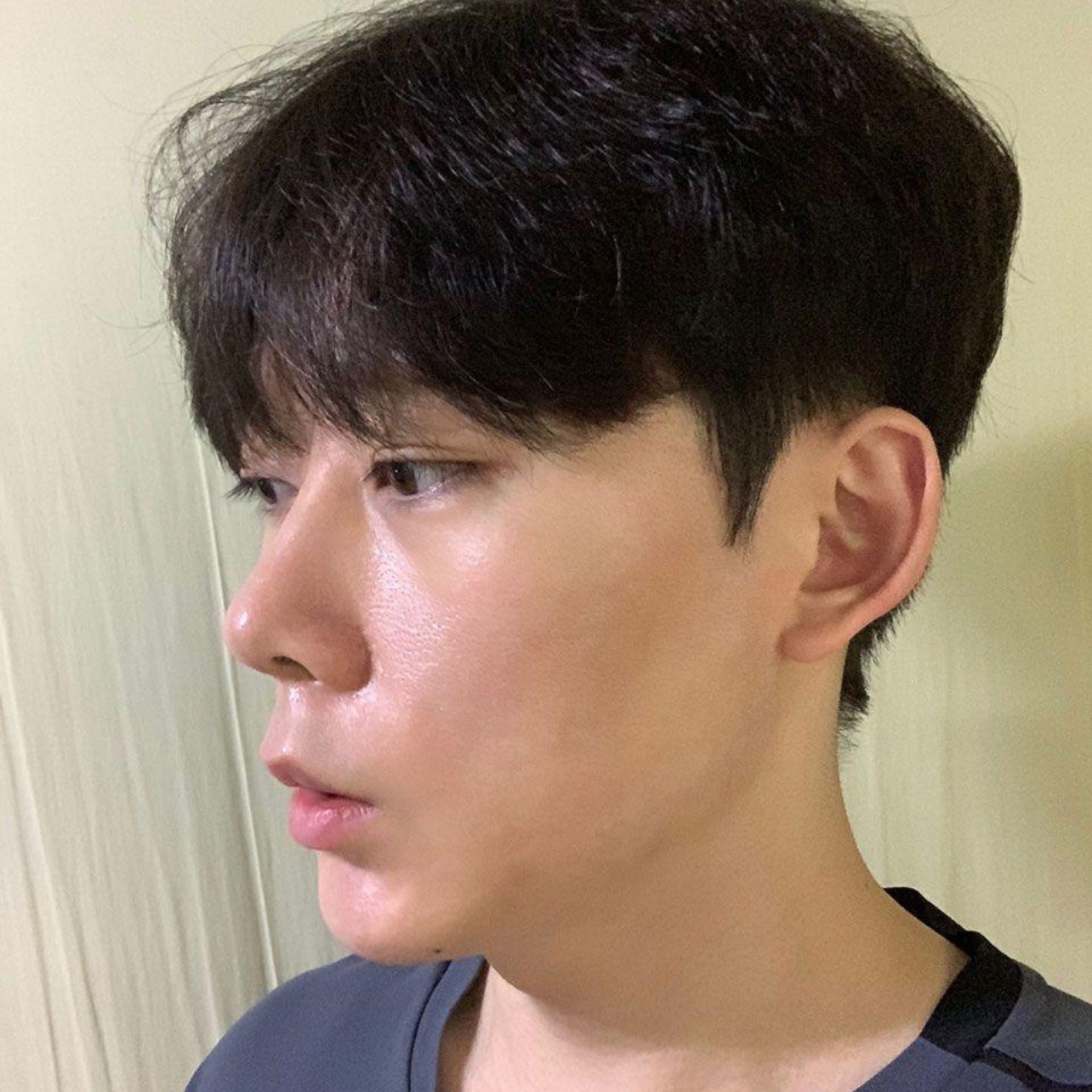 Mình đã phẫu thuật mũi với bác sĩ Shim Jung-hwan tại Webers Plastic Surgery được 2 tuần rồi