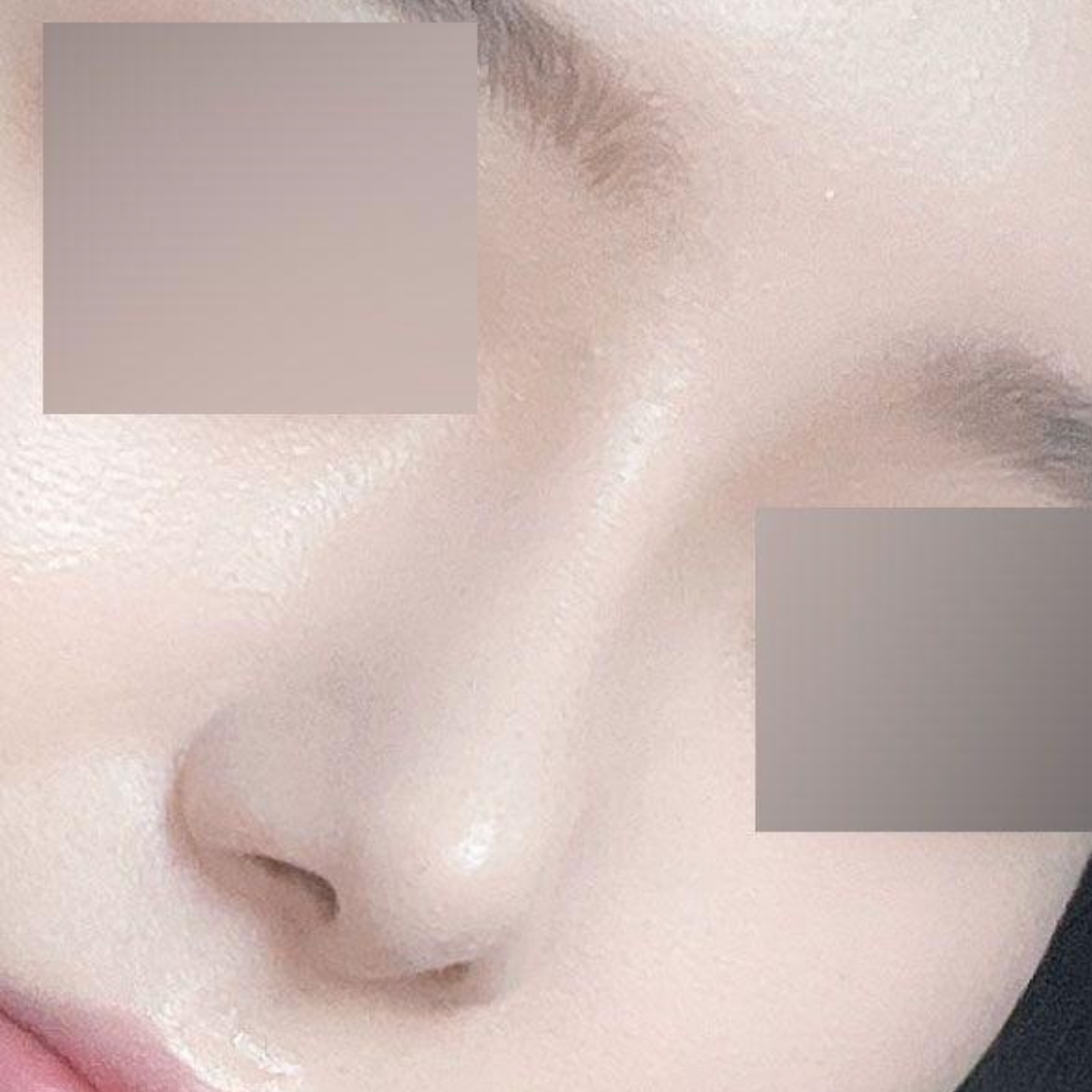 Đã được 1 tháng kể từ khi phẫu thuật