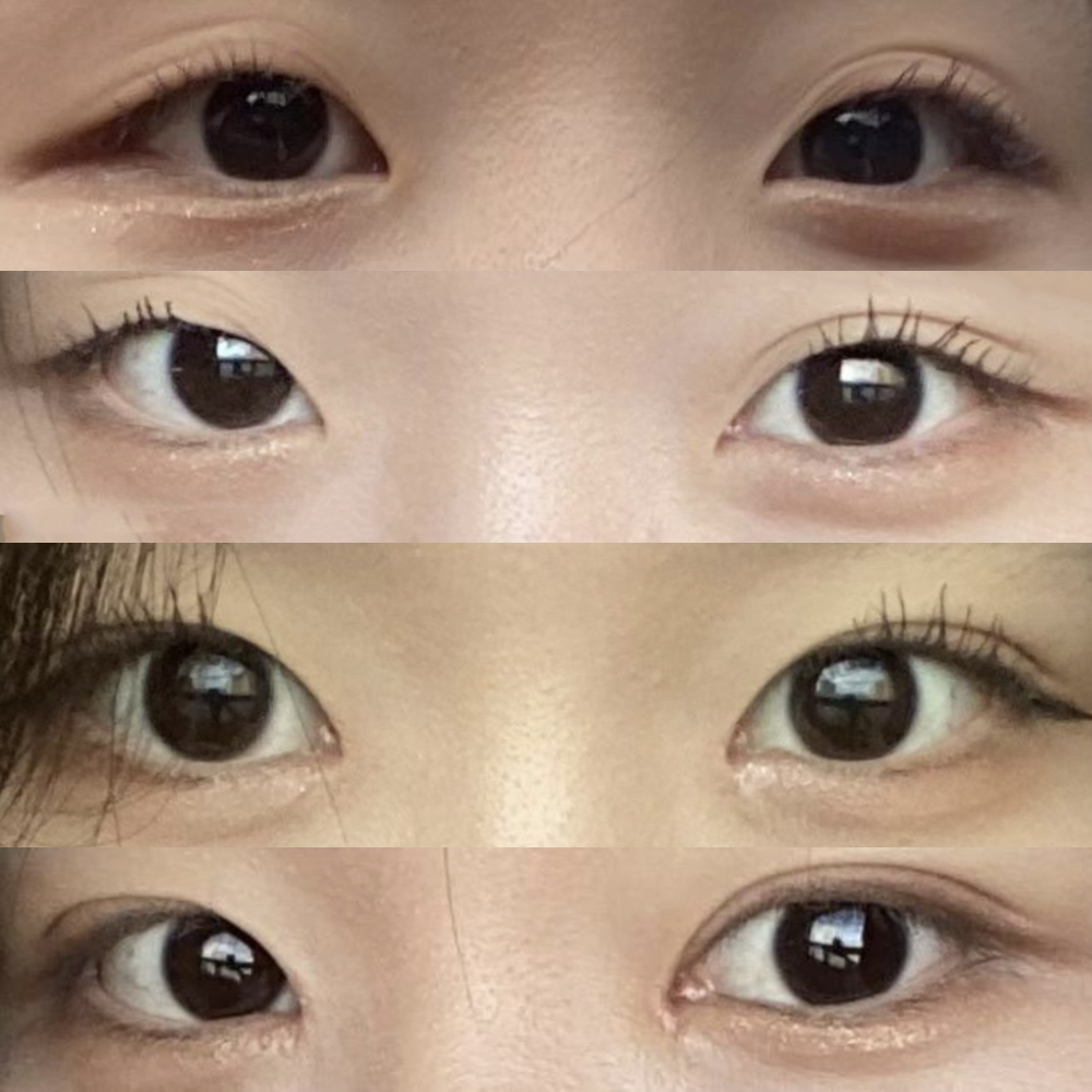 Mình đã phẫu thuật mắt :)